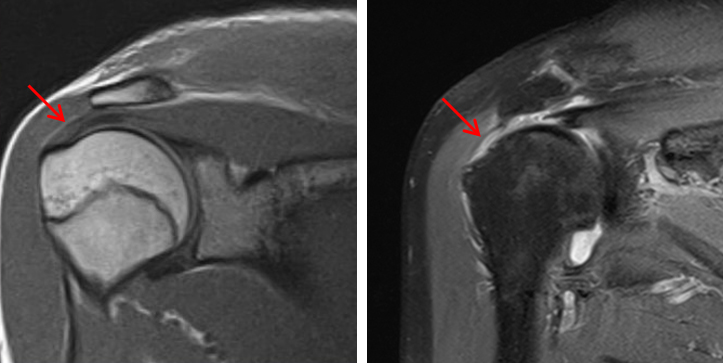 정상 소견과 회전근개가 파열된 어깨 MRI 사진 비교 이미지