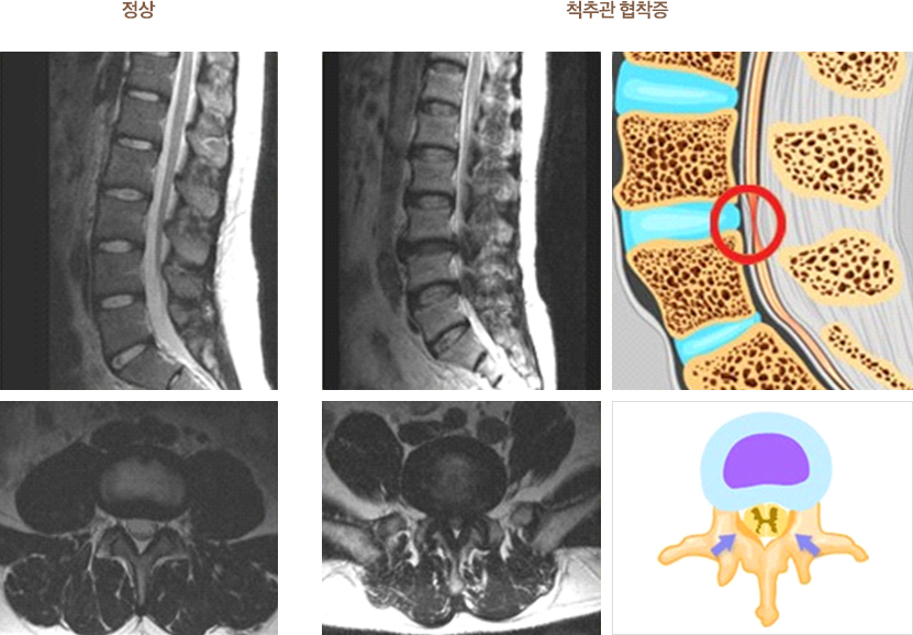 척추관 협착증 환자의 요추부 자기 공명 영상(MRI) 이미지