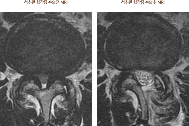 척추관 협착증 수술전,후 MRI 사진